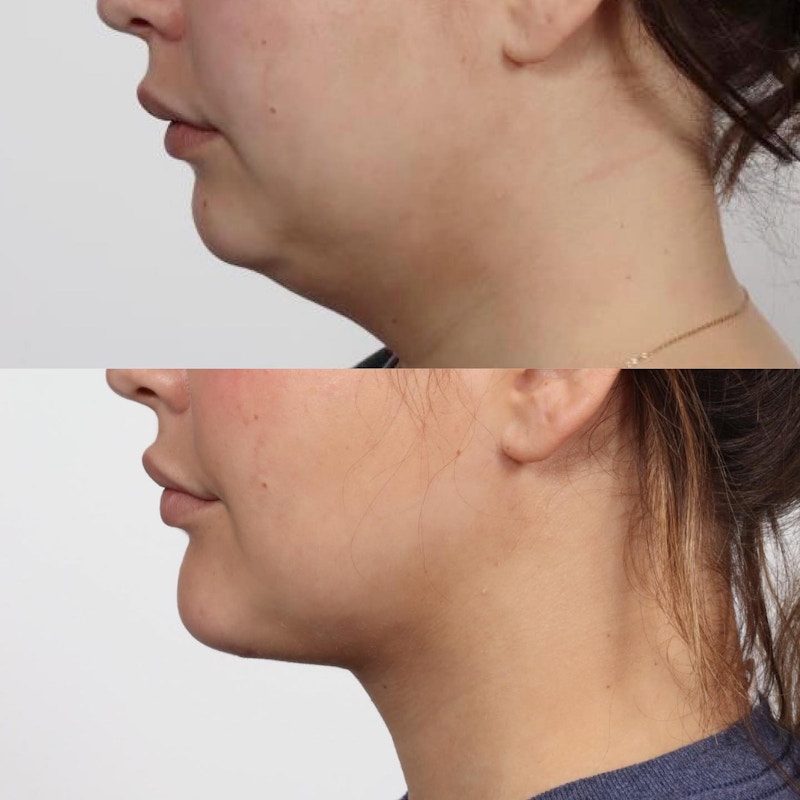 Deep Neck Lift Before & After Gallery - Patient 152568668 - Image 1
