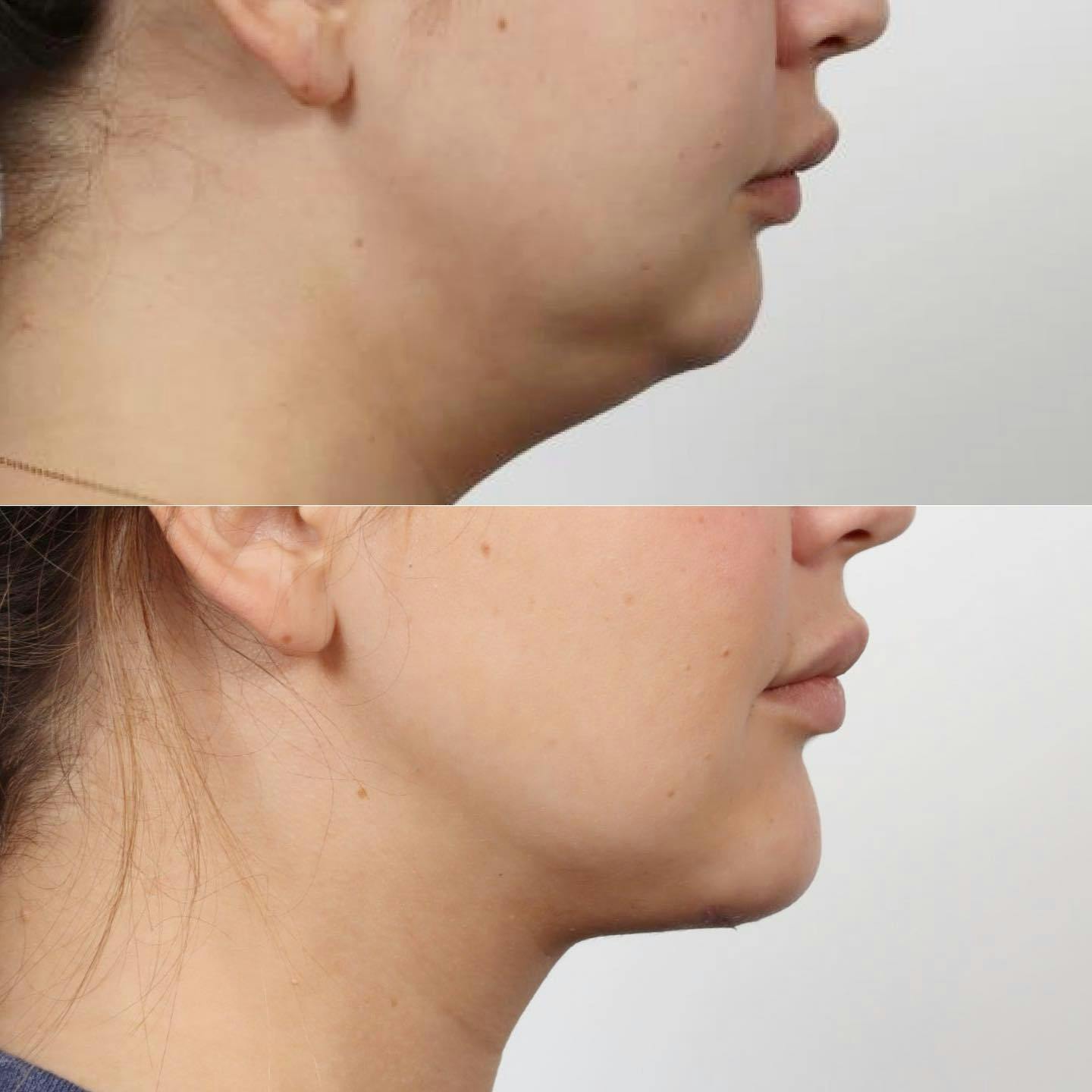 Deep Neck Lift Before & After Gallery - Patient 152568668 - Image 2