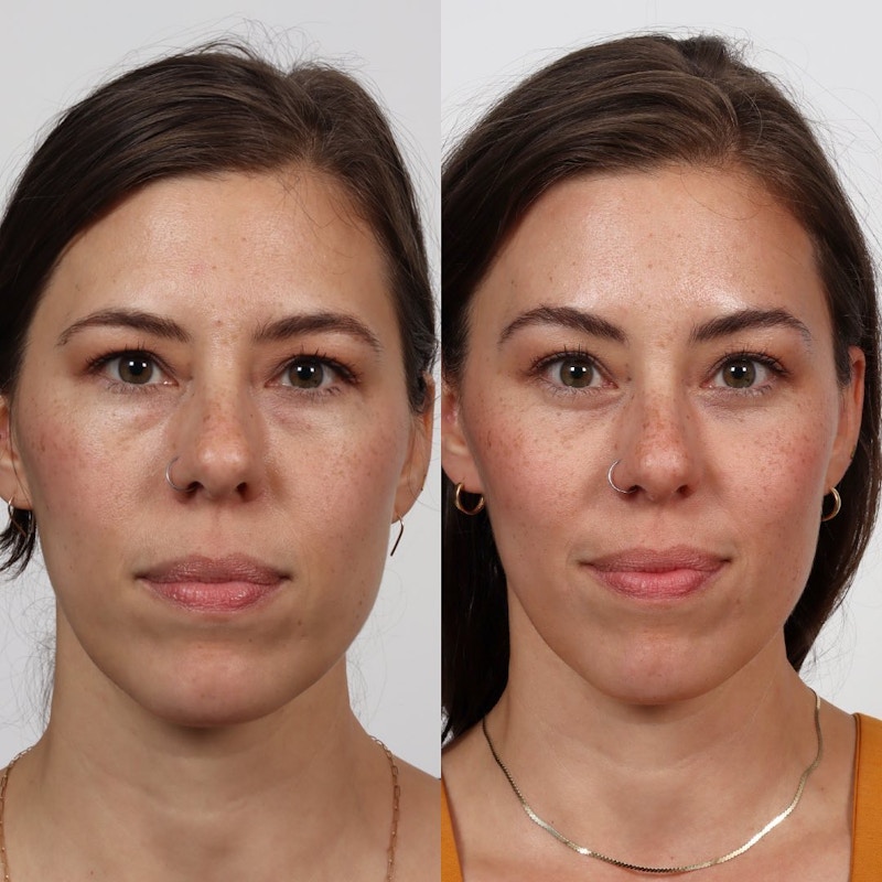 Eyelid Surgery (Blepharoplasty) Before & After Gallery - Patient 152568671 - Image 1