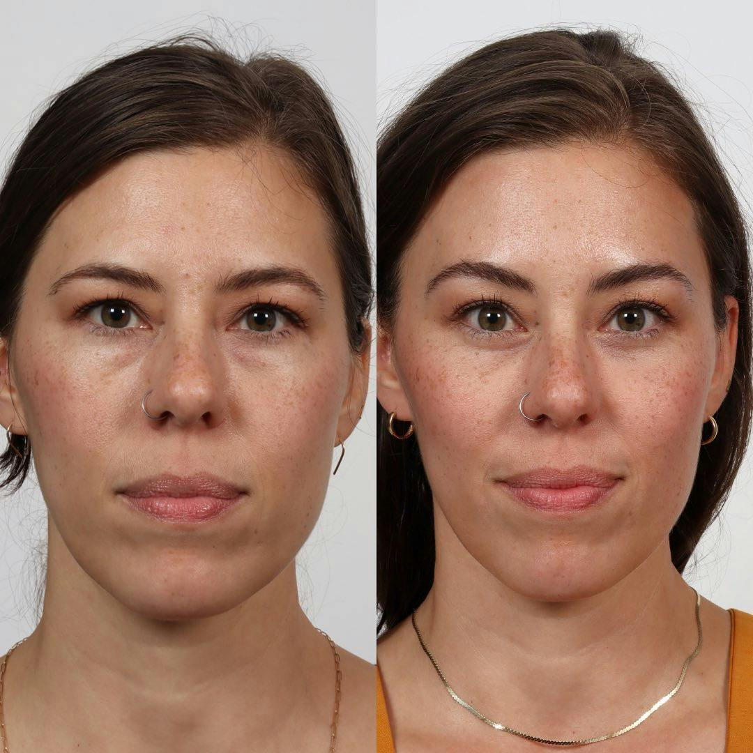 Brow Lift Before & After Gallery - Patient 152568669 - Image 1