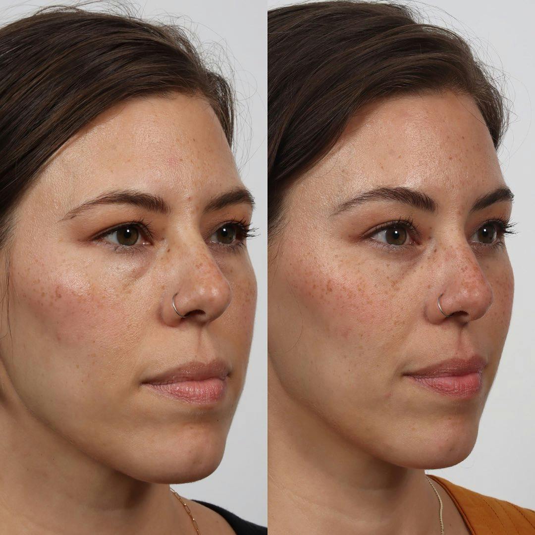 Eyelid Surgery Before & After Gallery - Patient 152568671 - Image 2