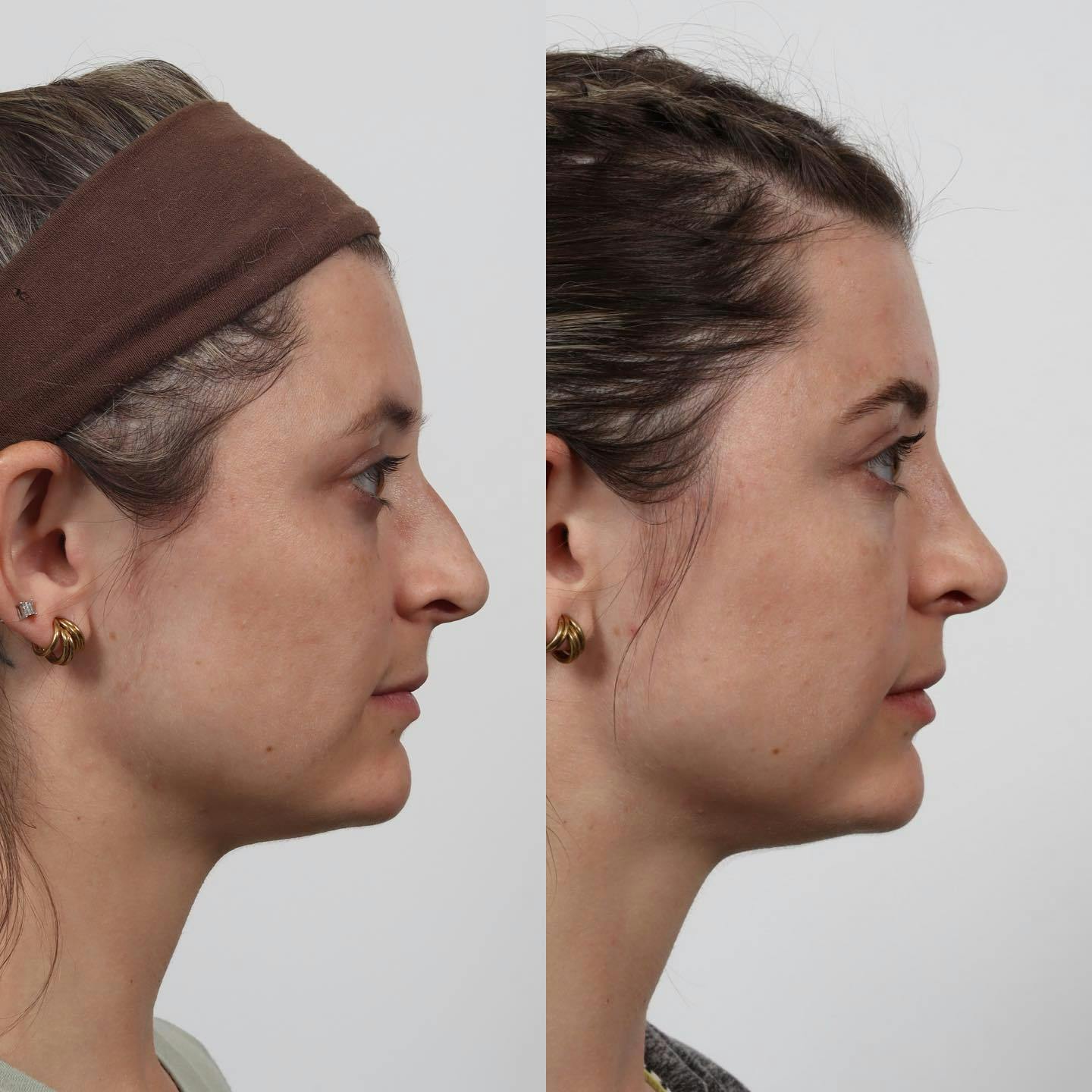 Rhinoplasty Before & After Gallery - Patient 152568673 - Image 2