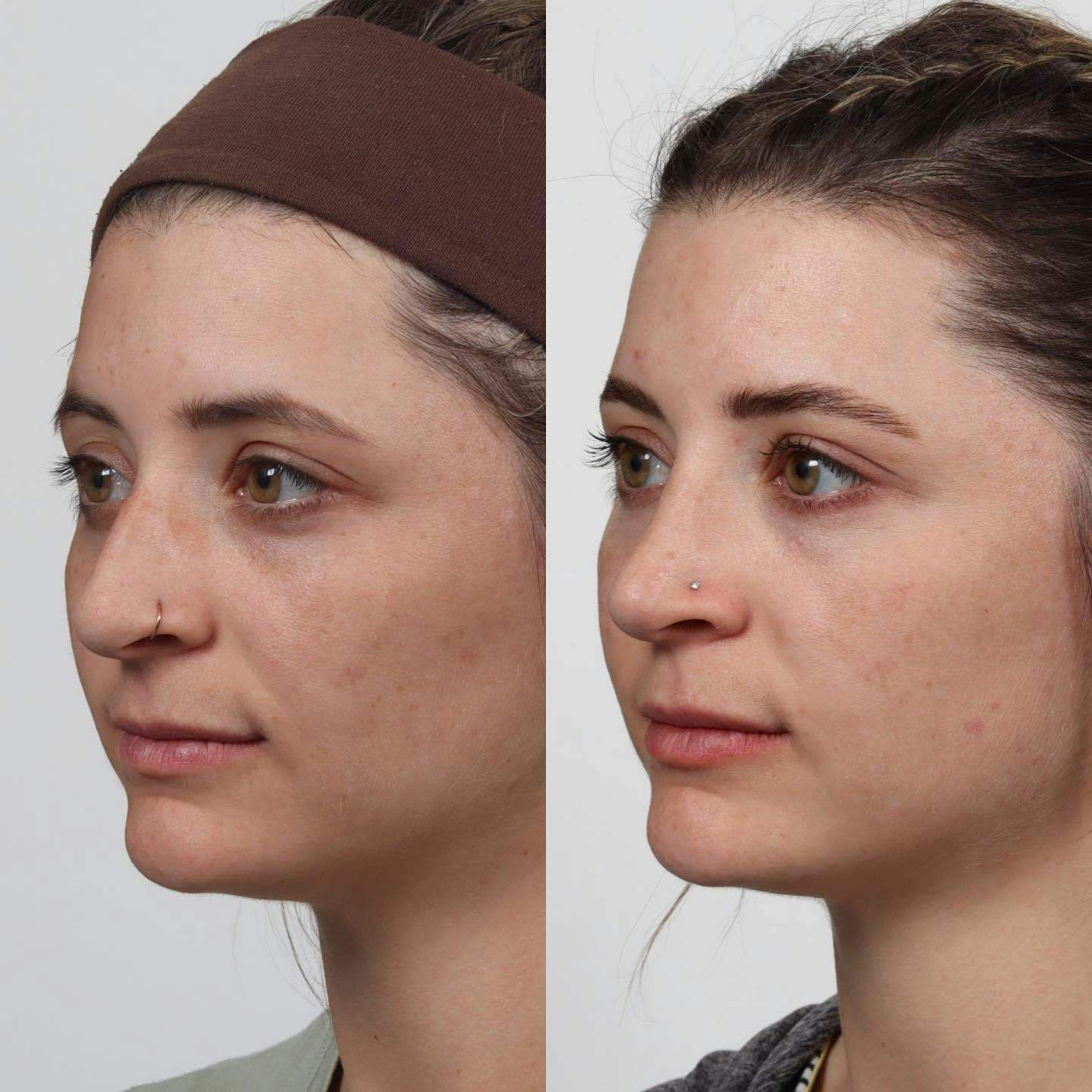Rhinoplasty Before & After Gallery - Patient 152568673 - Image 3