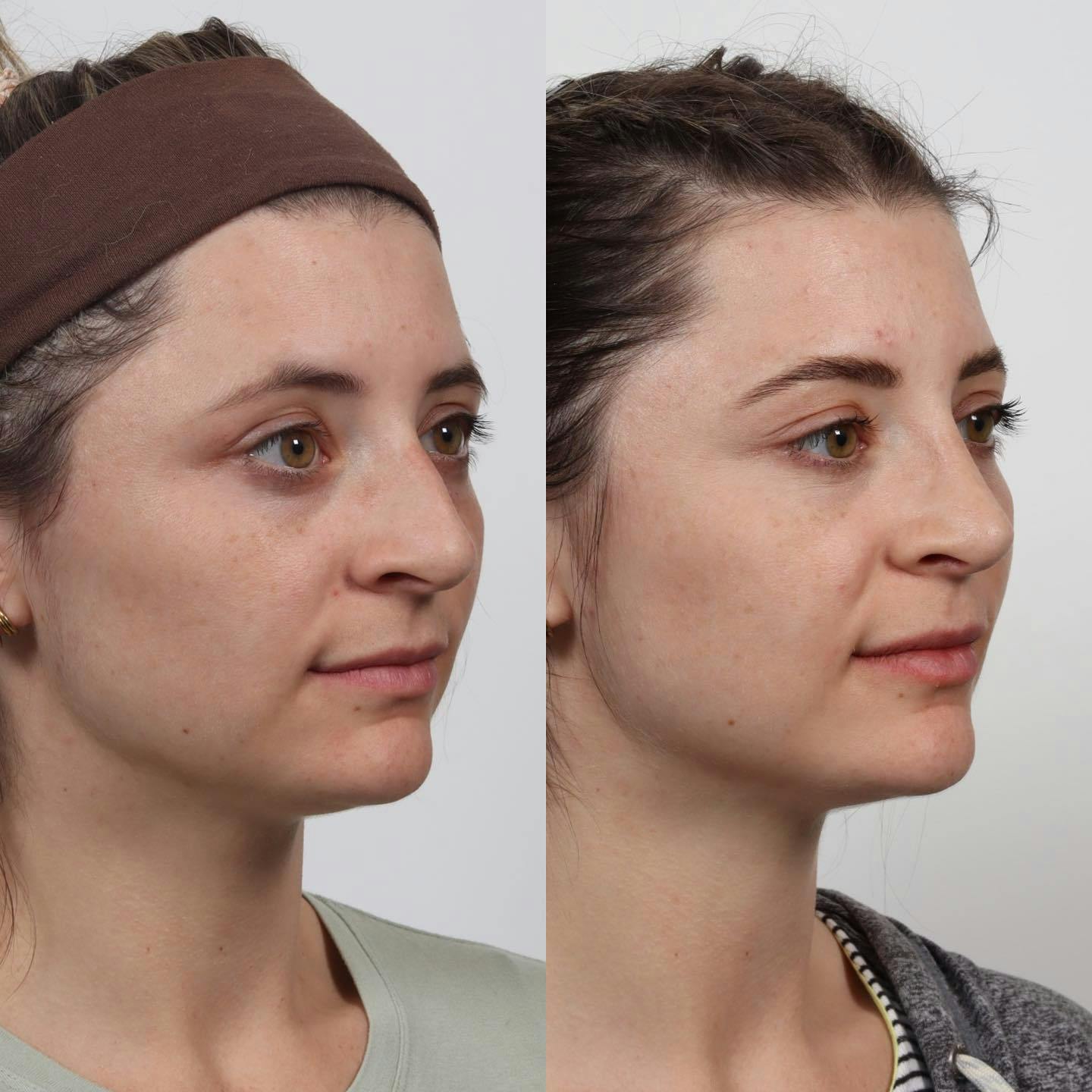 Rhinoplasty Before & After Gallery - Patient 152568673 - Image 4
