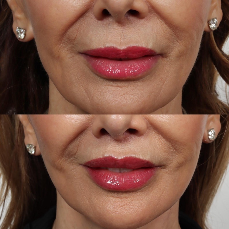 Lip Lift Before & After Gallery - Patient 152568674 - Image 1
