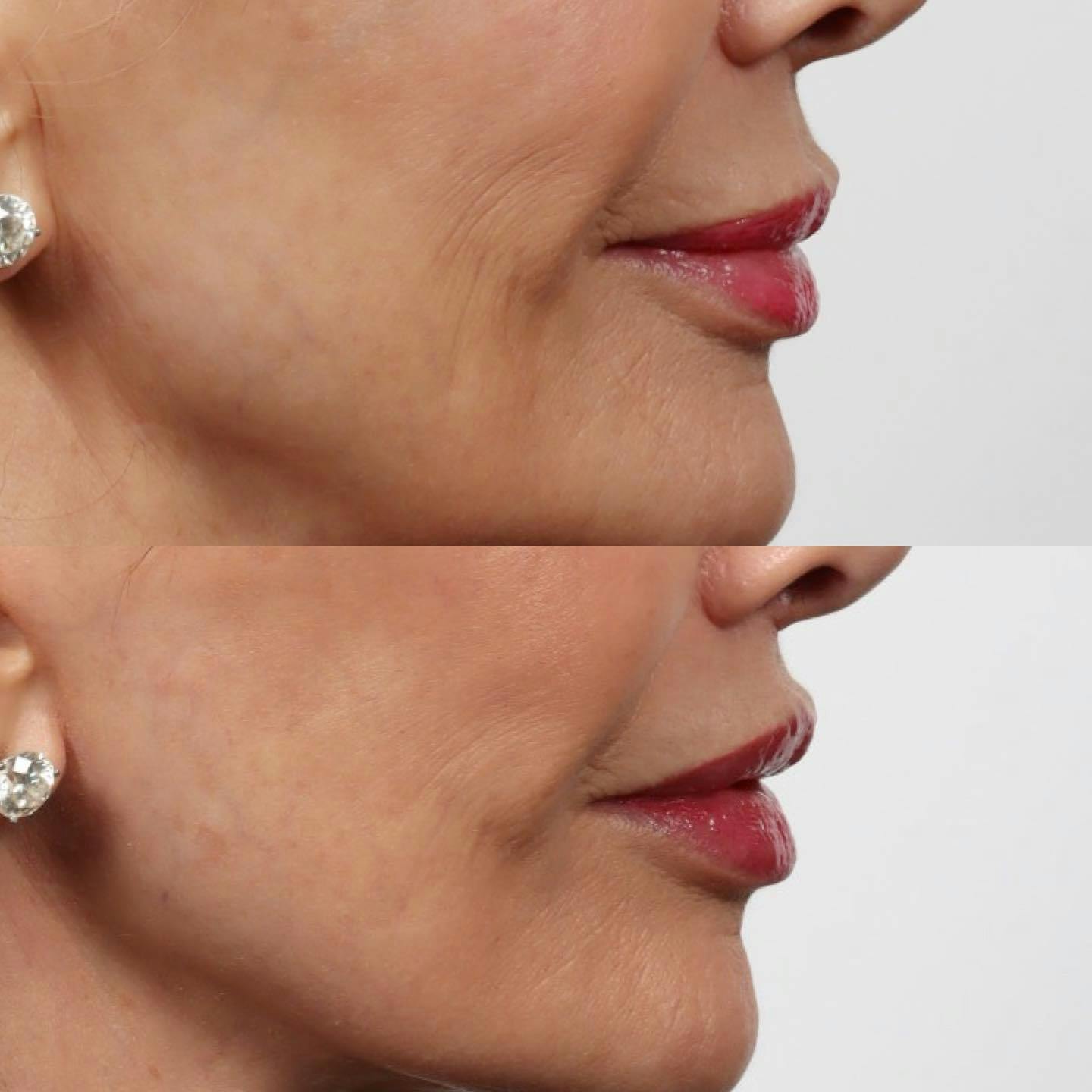 Lip Lift Before & After Gallery - Patient 152568674 - Image 2