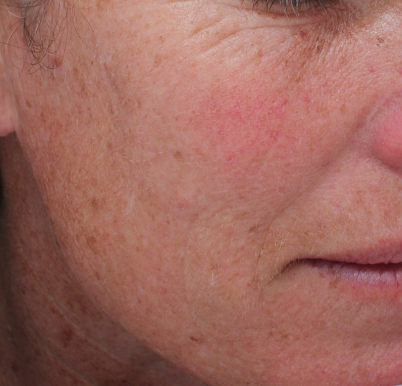 Moxi™ Laser Before & After Gallery - Patient 163262066 - Image 1