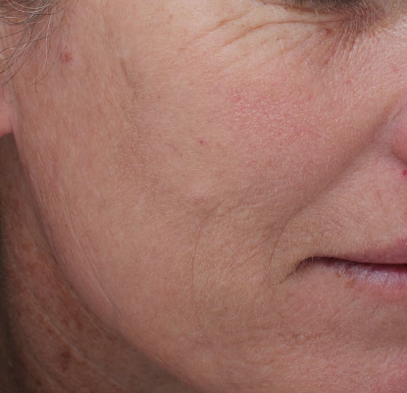 Moxi™ Laser Before & After Gallery - Patient 163262066 - Image 2