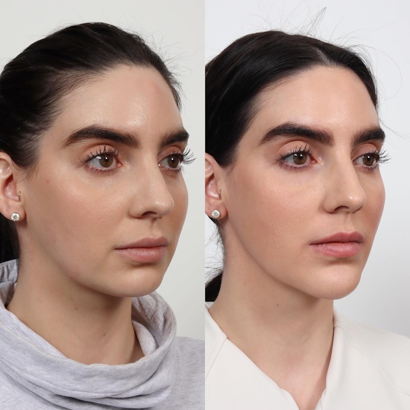Submental Liposuction Before & After Gallery - Patient 163262972 - Image 1
