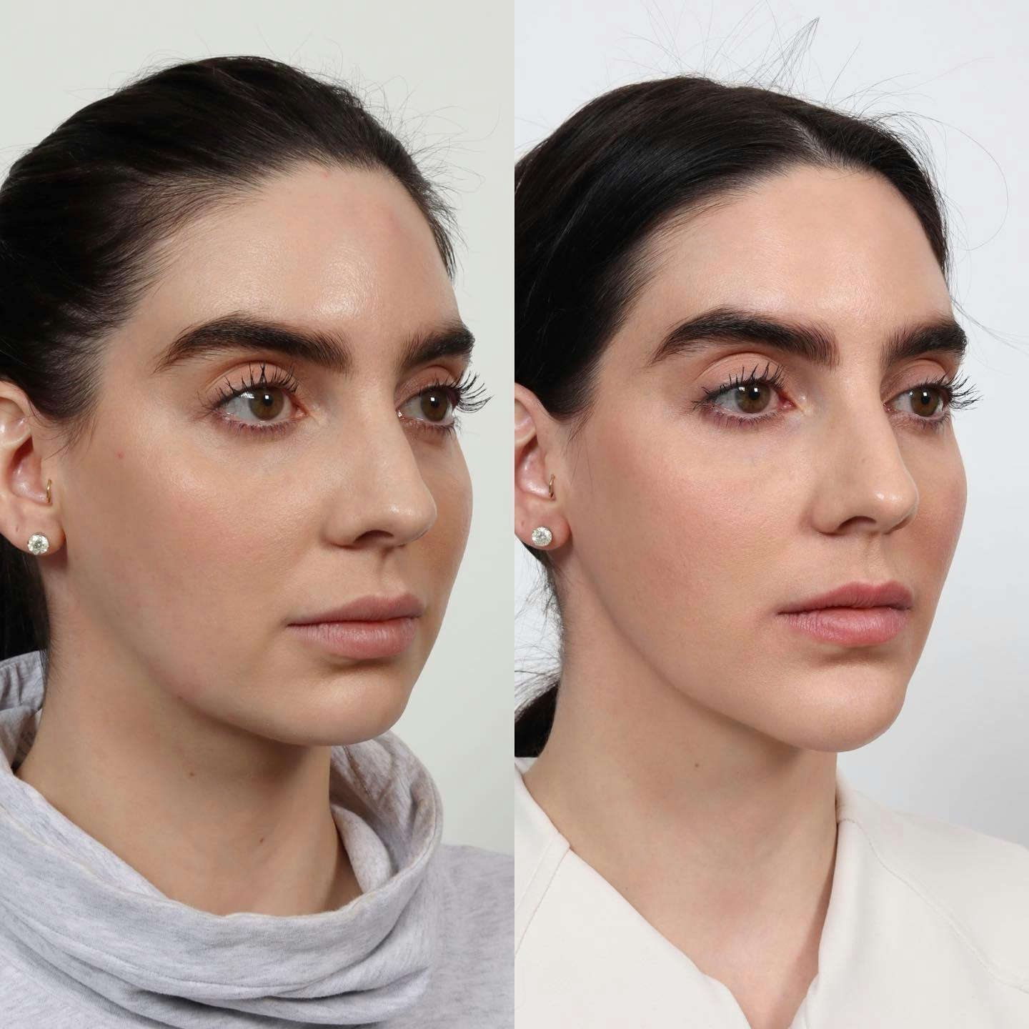Submental (Chin) Liposuction Before & After Gallery - Patient 163262972 - Image 1