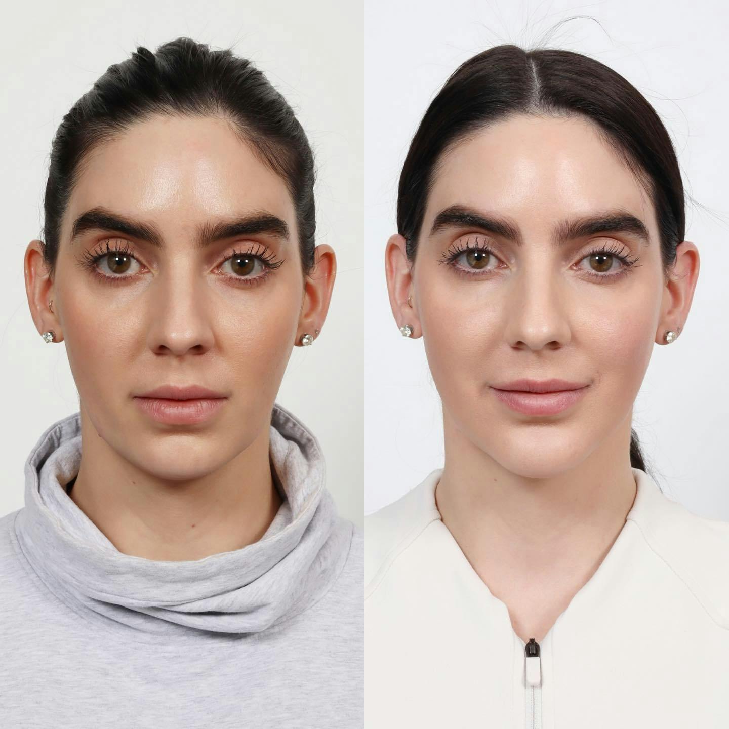 Submental (Chin) Liposuction Before & After Gallery - Patient 163262972 - Image 3