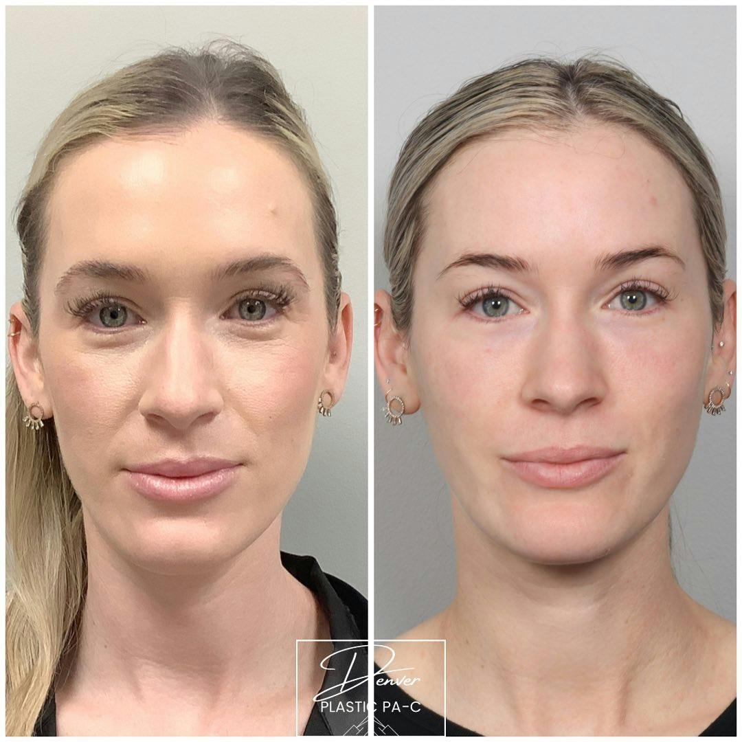 BOTOX®/Dysport Before & After Gallery - Patient 163262981 - Image 1