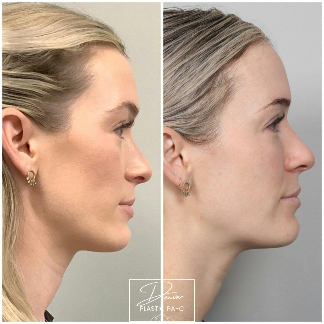 BOTOX®/Dysport Before & After Gallery - Patient 163262981 - Image 2