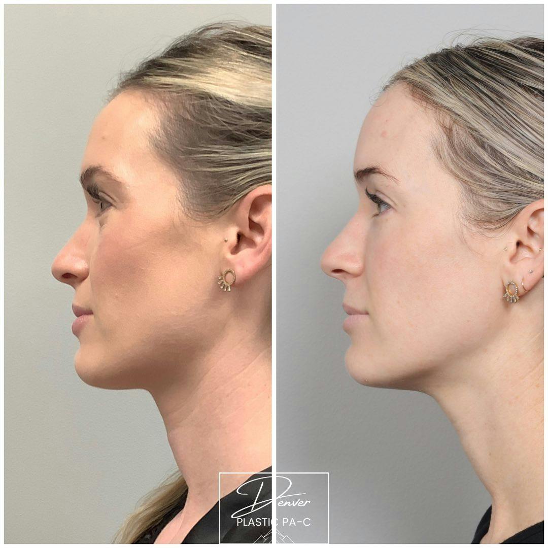 Sculptra Before & After Gallery - Patient 163262979 - Image 3