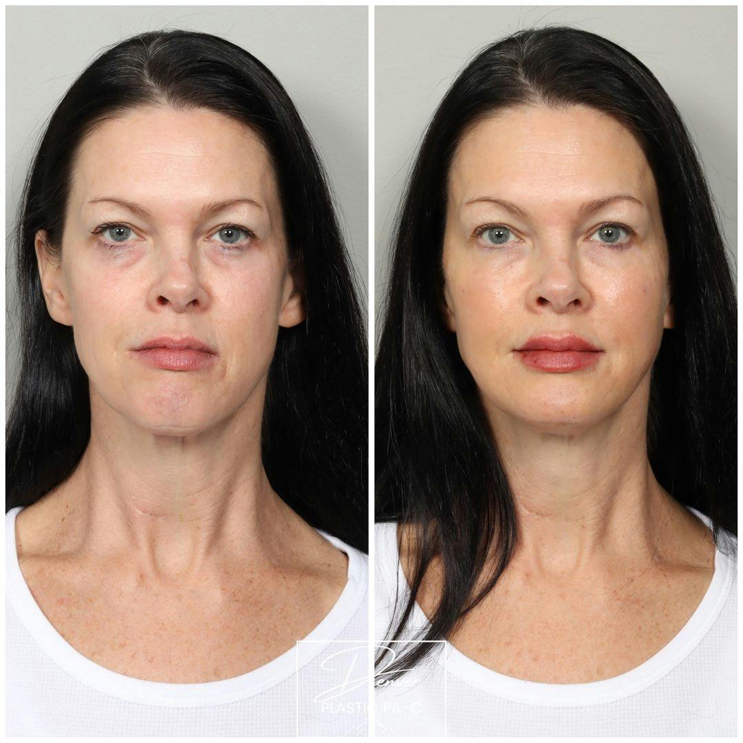 Facial Rejuvenation Before & After Gallery - Patient 163263025 - Image 1