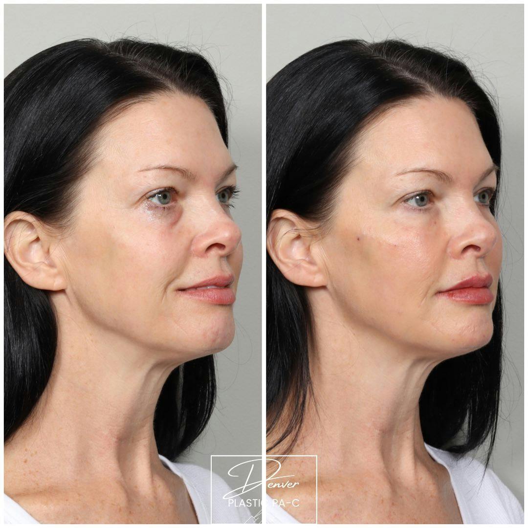 Facial Rejuvenation Before & After Gallery - Patient 163263025 - Image 2