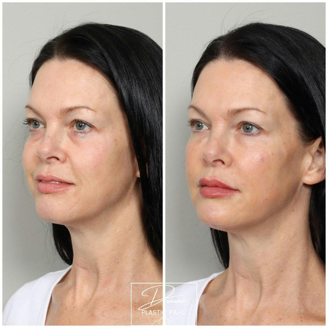 Facial Rejuvenation Before & After Gallery - Patient 163263025 - Image 3