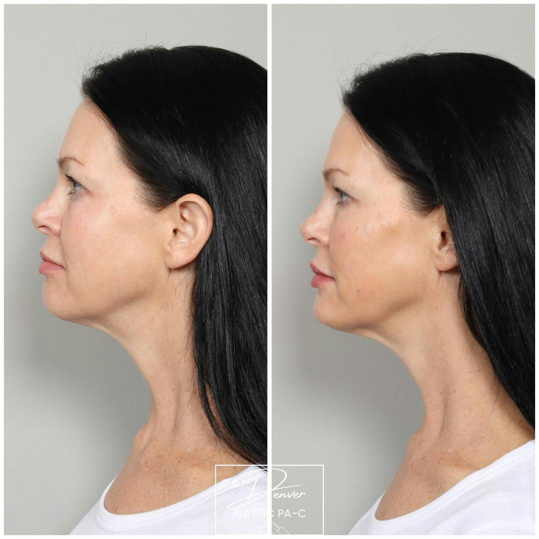 Facial Rejuvenation Before & After Gallery - Patient 163263025 - Image 4