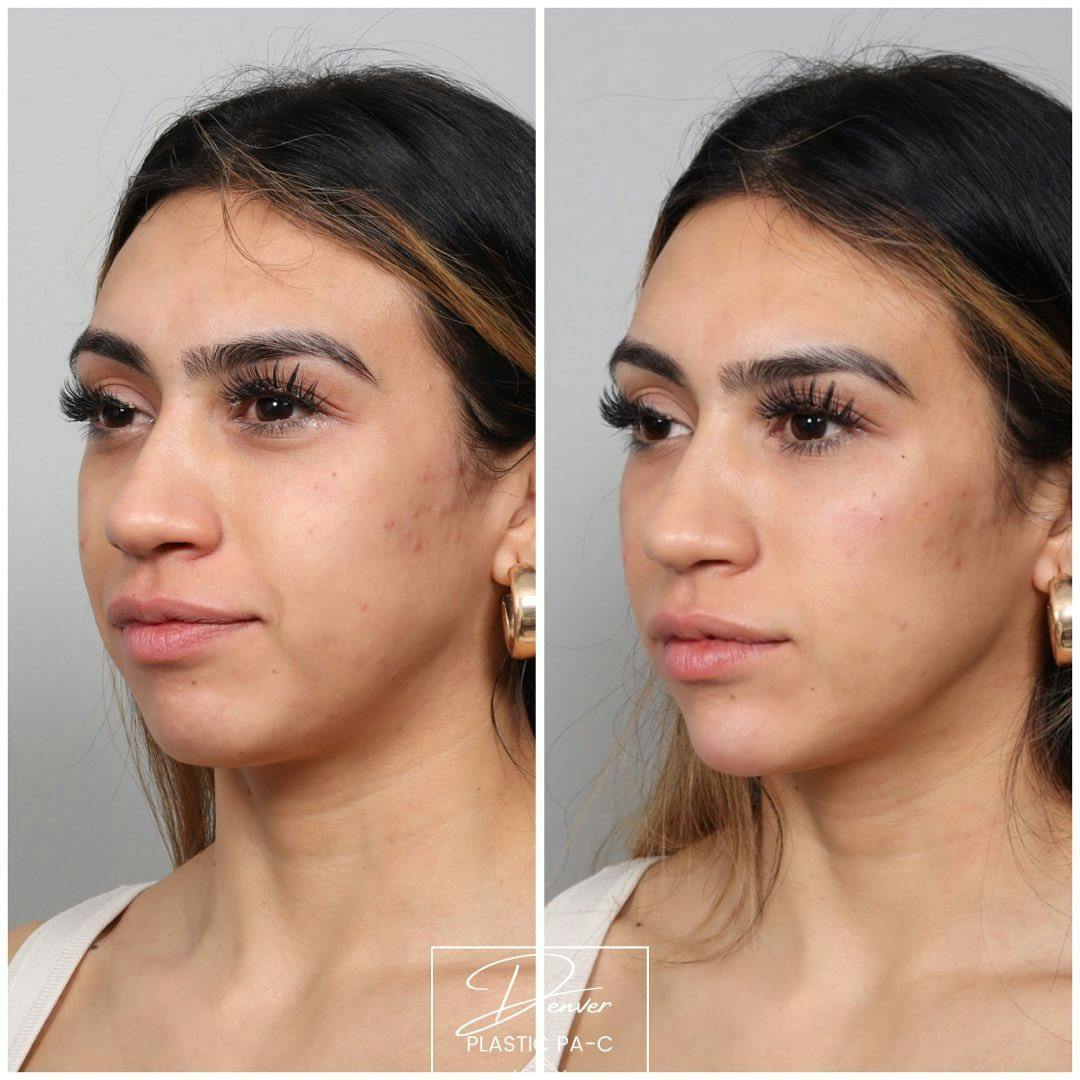 Facial Rejuvenation Before & After Gallery - Patient 163263027 - Image 1