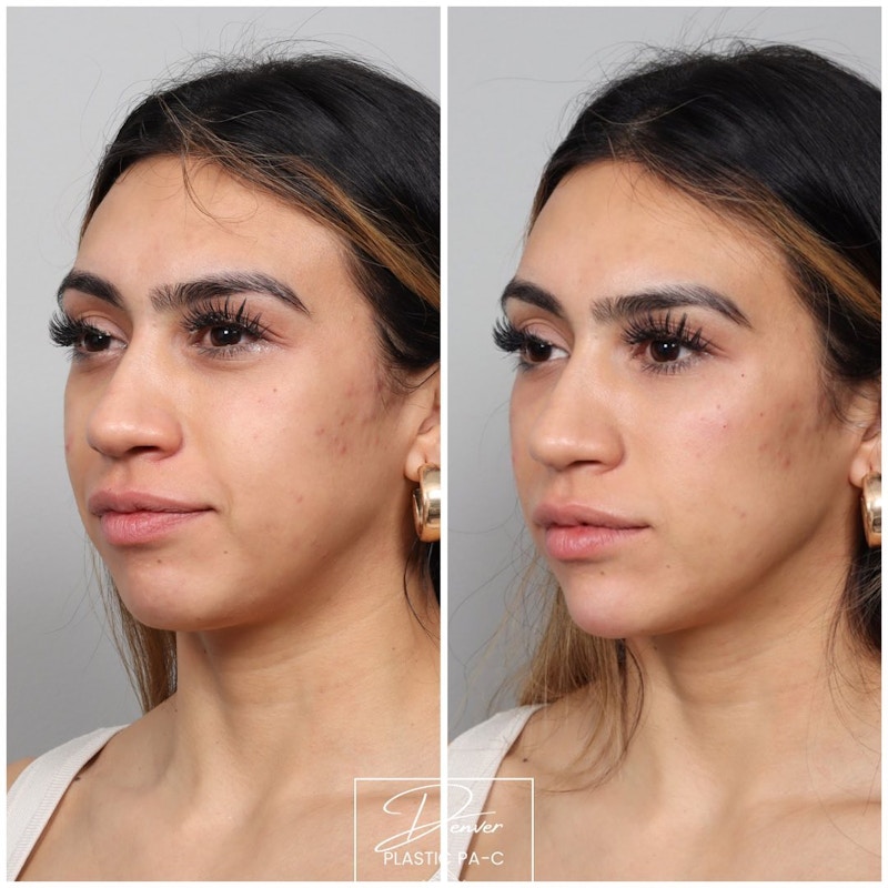 Facial Rejuvenation Before & After Gallery - Patient 163263027 - Image 1