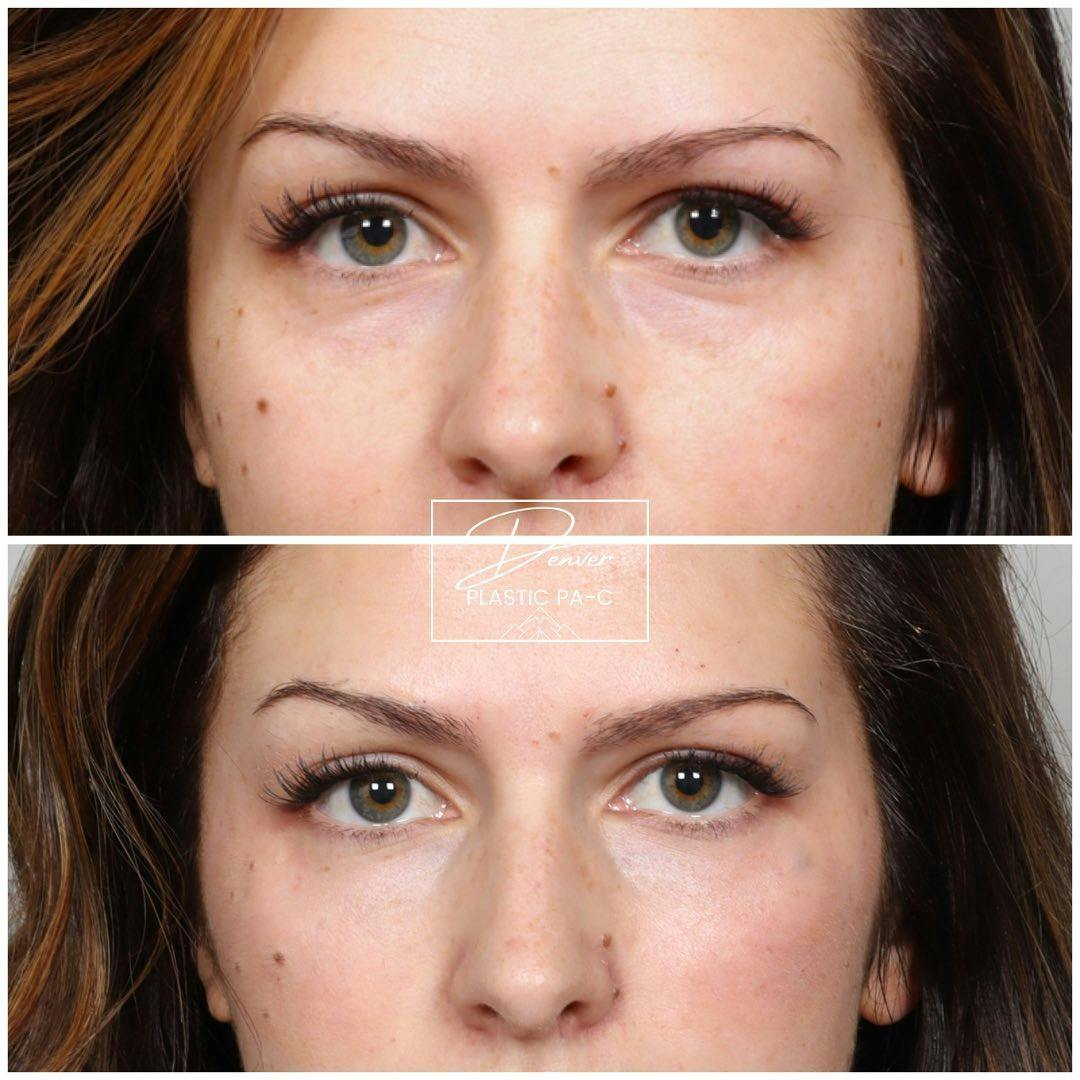 Under Eye Filler Before & After Gallery - Patient 163263031 - Image 1