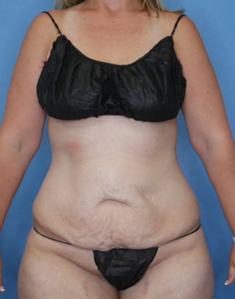 Tummy Tuck (Abdominoplasty)  Before & After Gallery - Patient 133182832 - Image 1