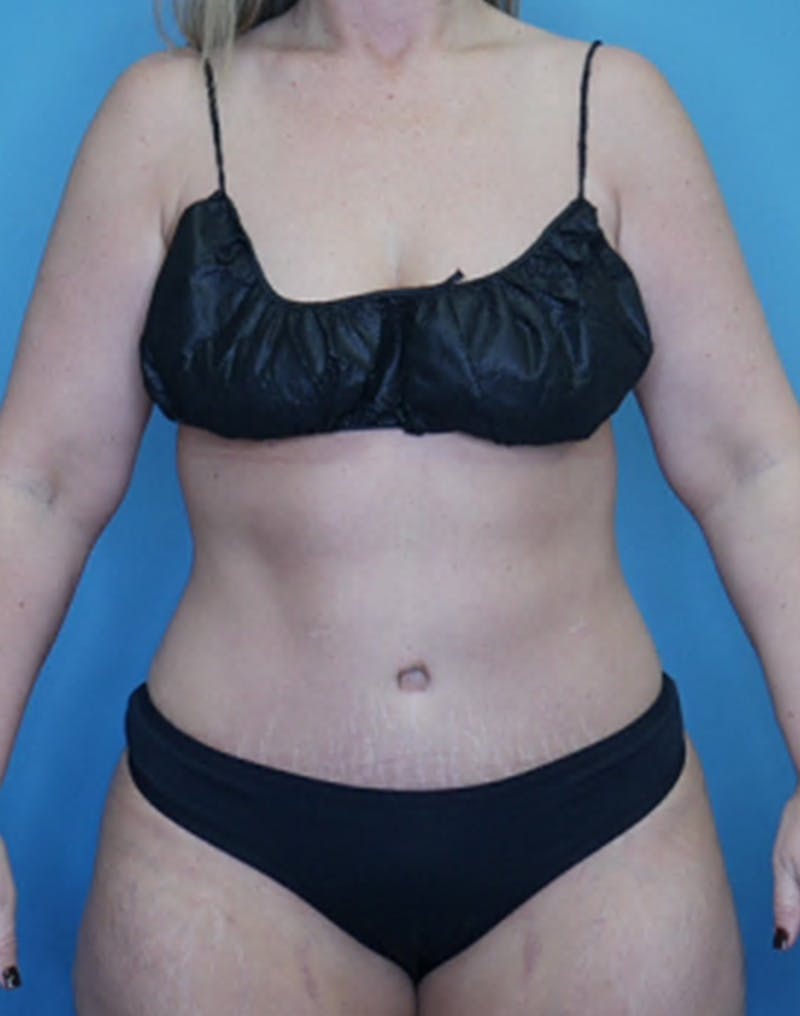 Tummy Tuck (Abdominoplasty)  Before & After Gallery - Patient 133182832 - Image 2