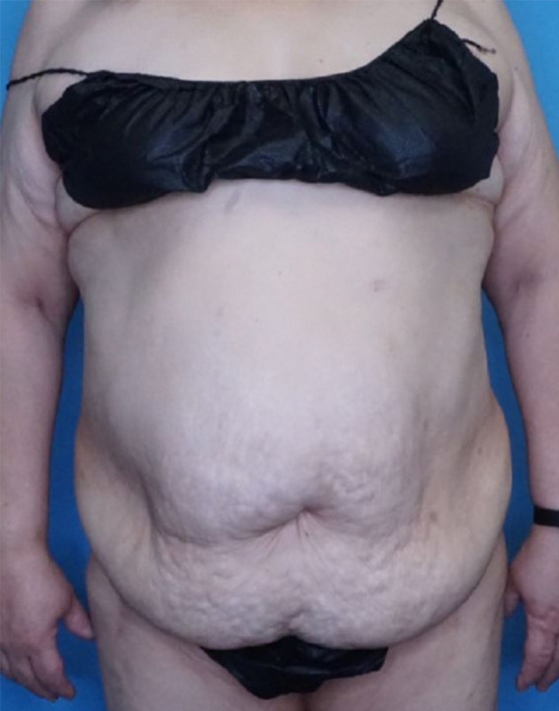 Tummy Tuck (Abdominoplasty)  Before & After Gallery - Patient 83594476 - Image 1
