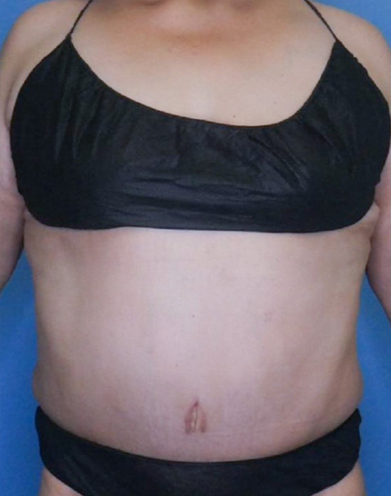 Tummy Tuck (Abdominoplasty)  Before & After Gallery - Patient 83594476 - Image 2