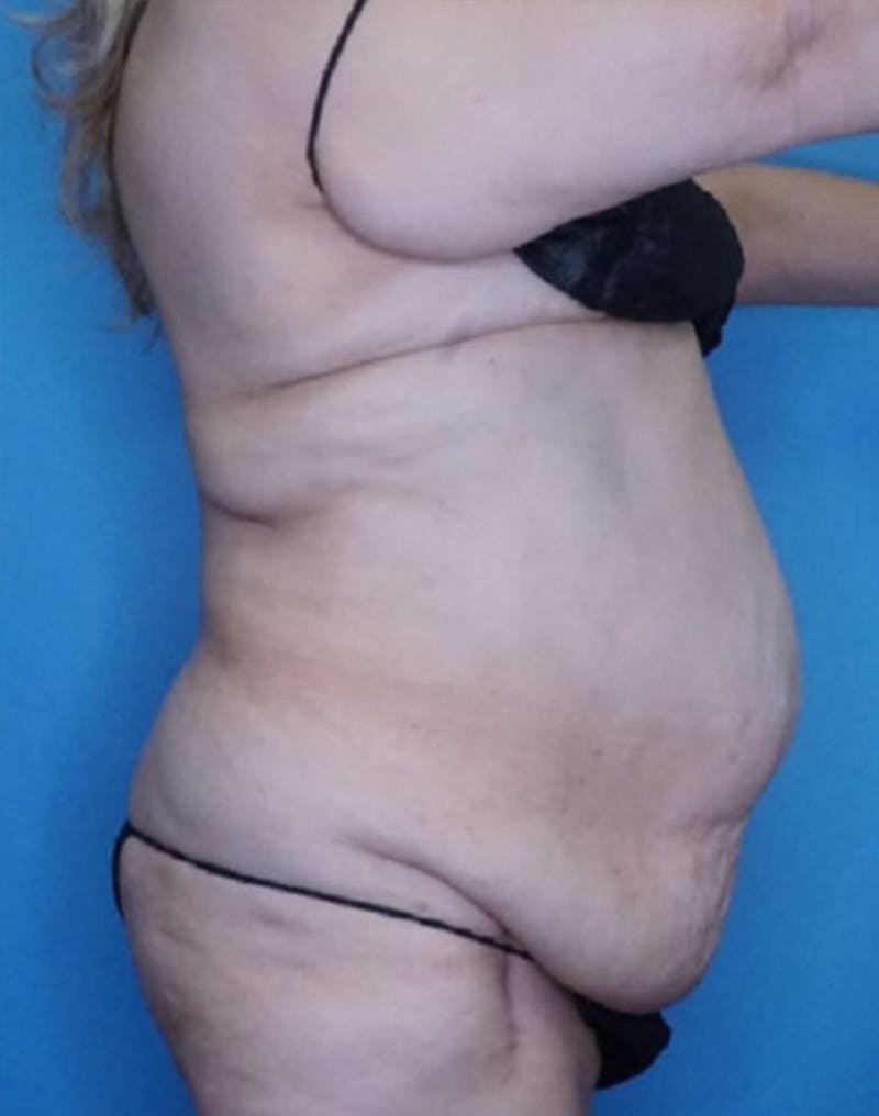 Tummy Tuck (Abdominoplasty)  Before & After Gallery - Patient 83594476 - Image 3