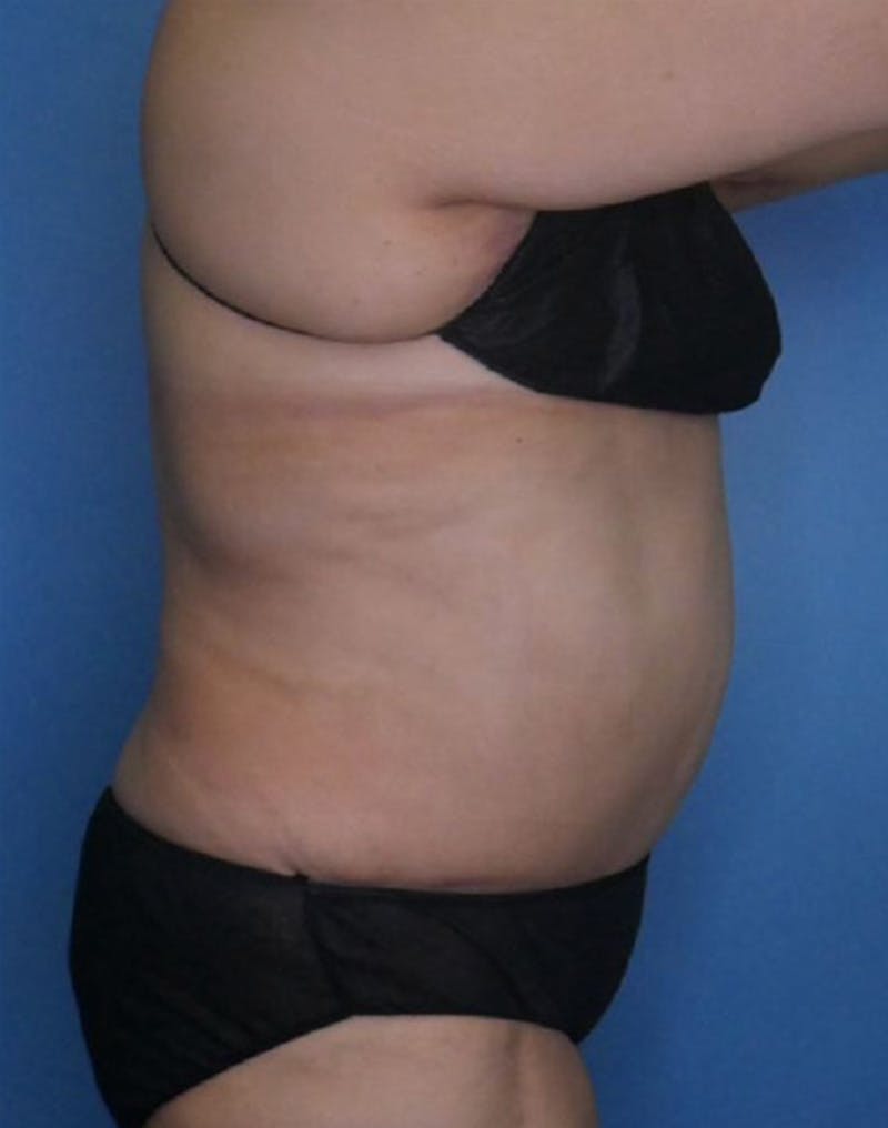 Tummy Tuck (Abdominoplasty)  Before & After Gallery - Patient 83594476 - Image 4