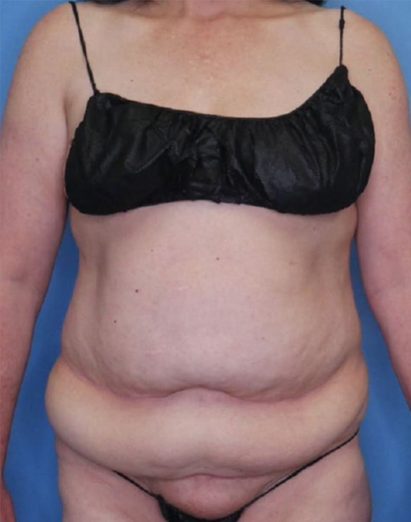 Tummy Tuck (Abdominoplasty)  Before & After Gallery - Patient 83594473 - Image 1