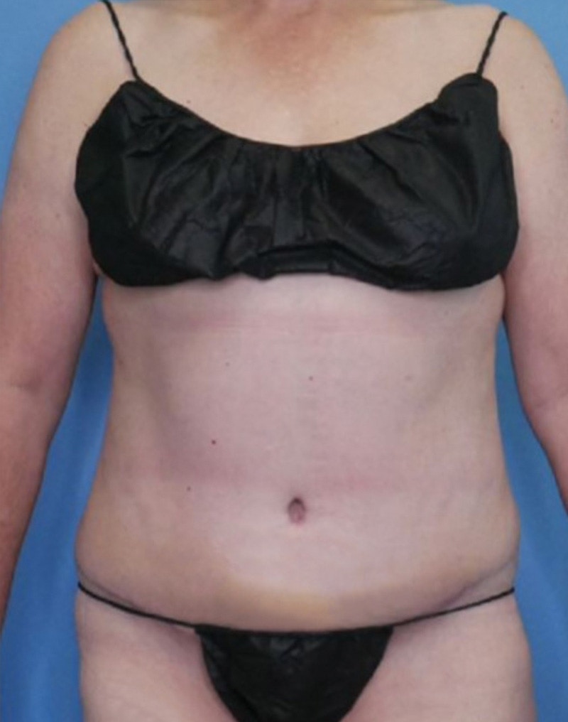 Tummy Tuck (Abdominoplasty)  Before & After Gallery - Patient 83594473 - Image 2