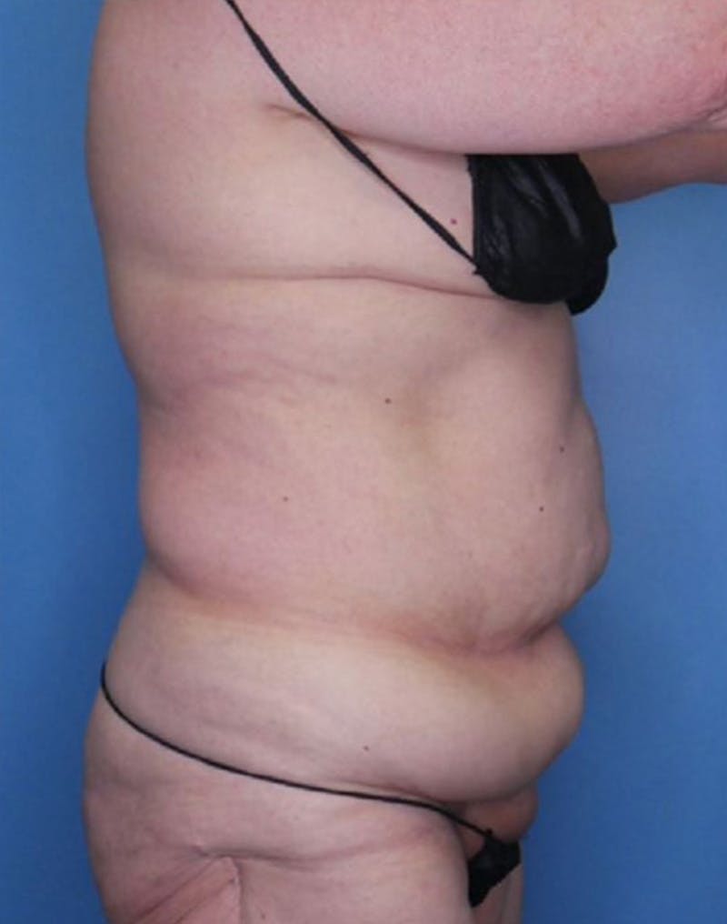 Tummy Tuck (Abdominoplasty)  Before & After Gallery - Patient 83594473 - Image 3