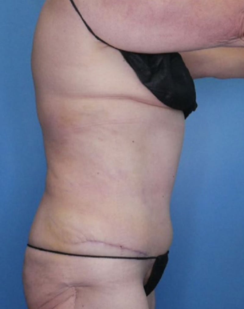 Tummy Tuck (Abdominoplasty)  Before & After Gallery - Patient 83594473 - Image 4