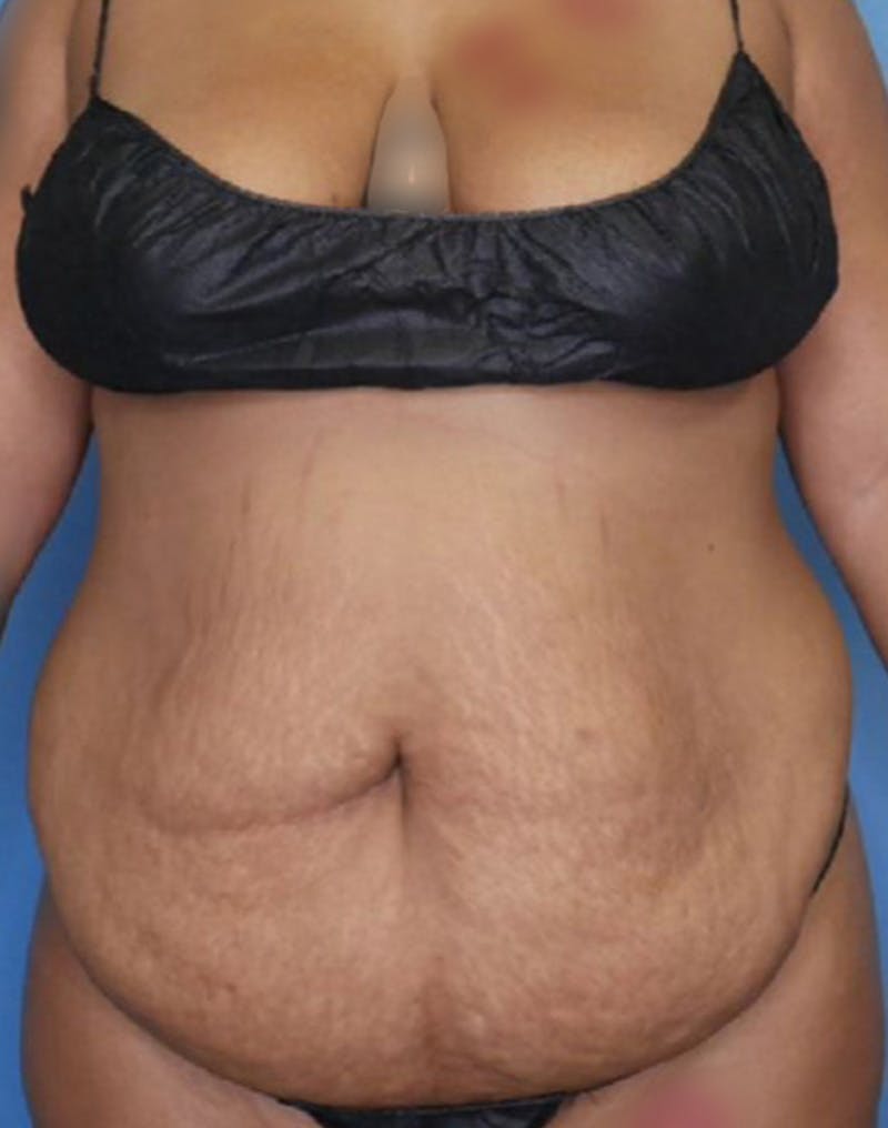 Tummy Tuck (Abdominoplasty)  Before & After Gallery - Patient 83594440 - Image 1