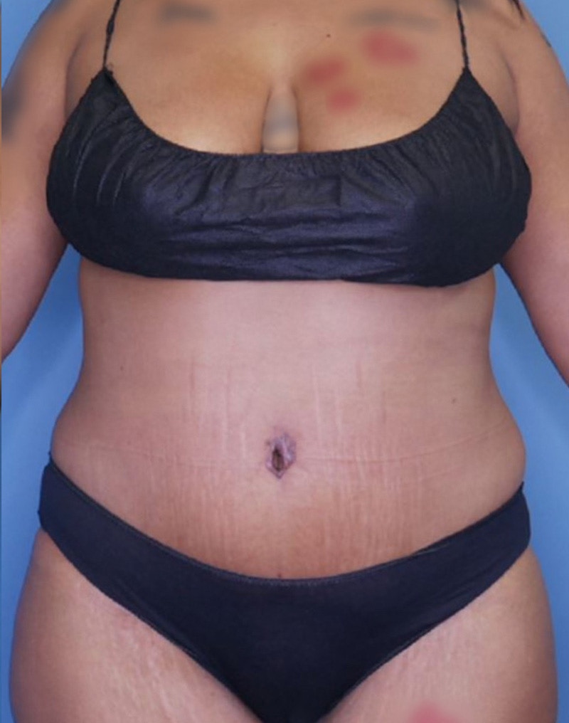 Tummy Tuck (Abdominoplasty)  Before & After Gallery - Patient 83594440 - Image 2
