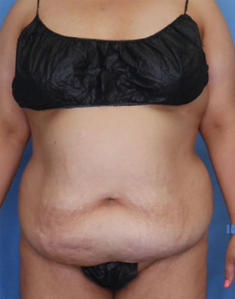 Tummy Tuck (Abdominoplasty)  Before & After Gallery - Patient 83594441 - Image 1