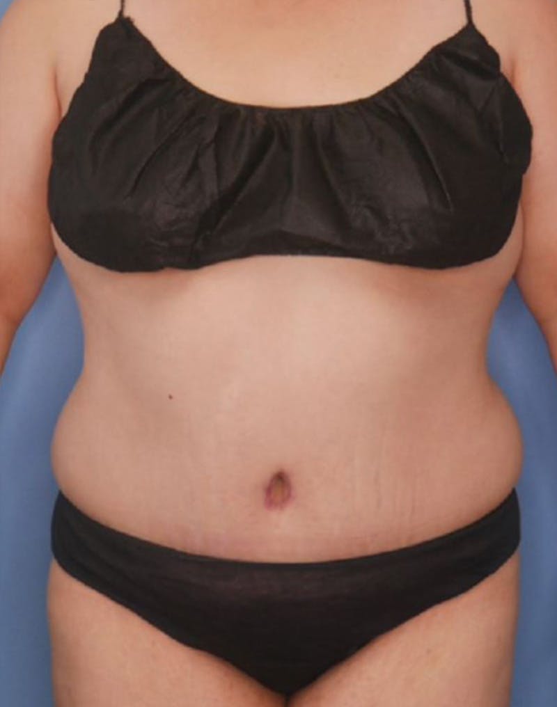 Tummy Tuck (Abdominoplasty)  Before & After Gallery - Patient 83594441 - Image 2