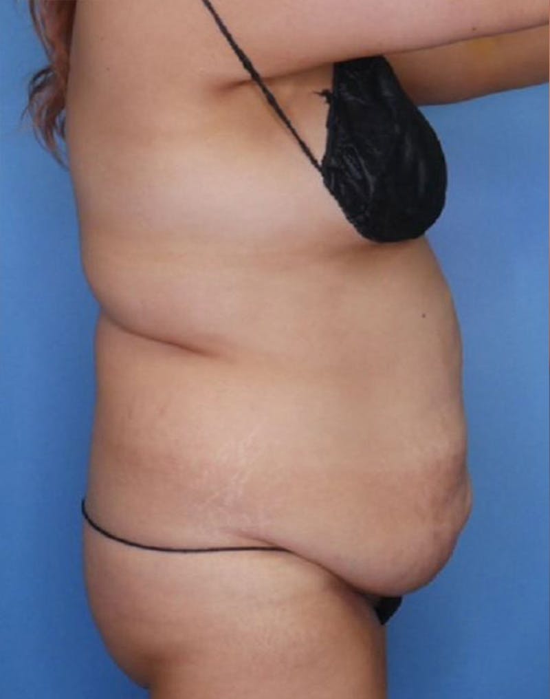 Tummy Tuck (Abdominoplasty)  Before & After Gallery - Patient 83594441 - Image 3