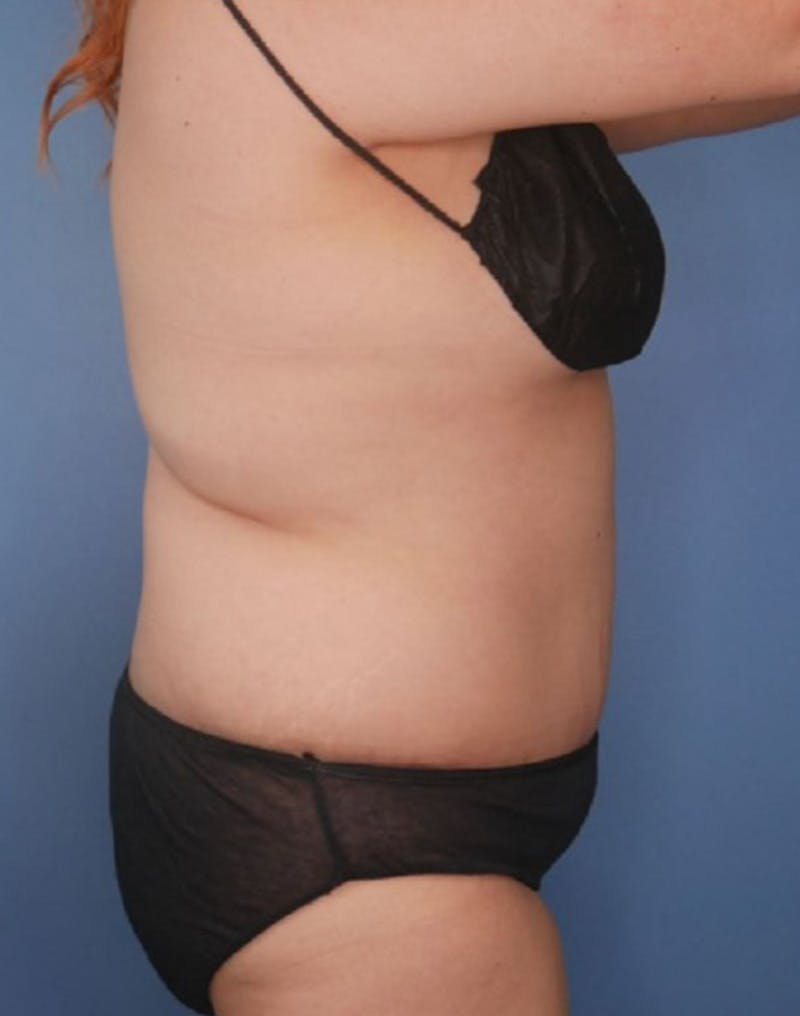 Tummy Tuck (Abdominoplasty)  Before & After Gallery - Patient 83594441 - Image 4