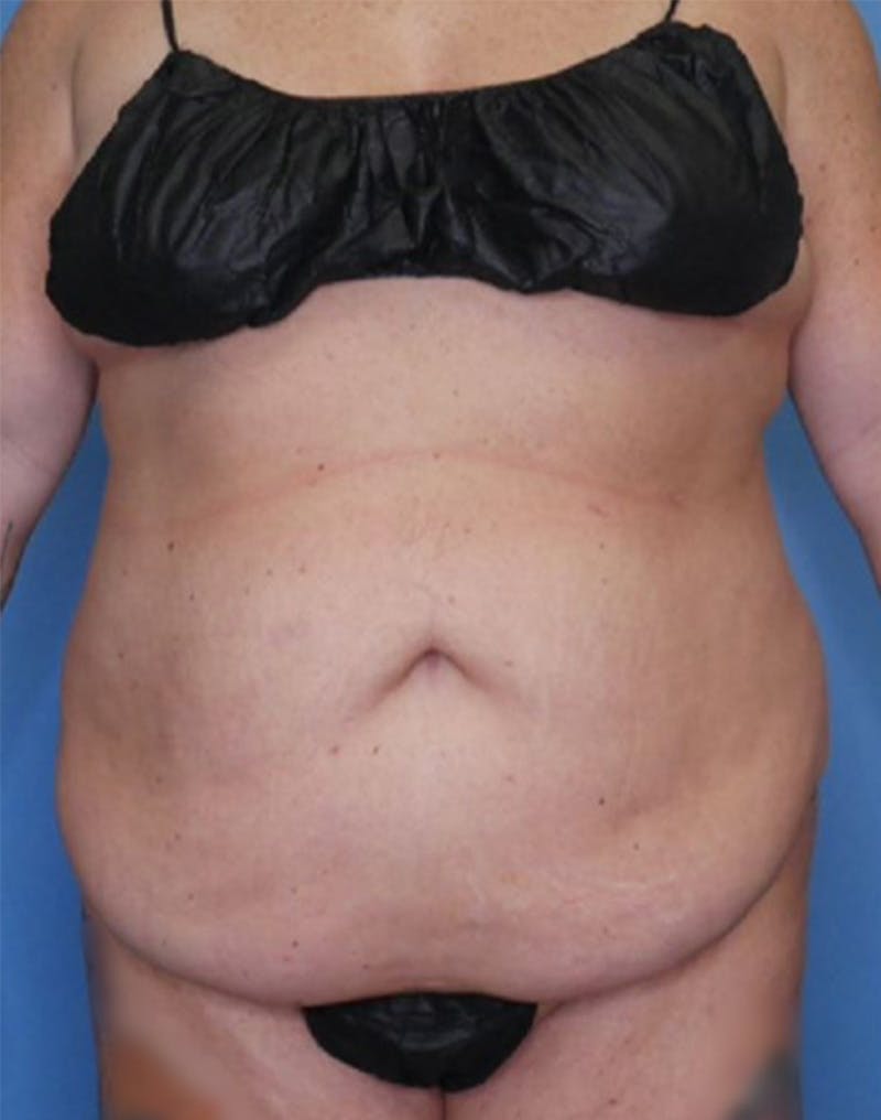 Tummy Tuck (Abdominoplasty)  Before & After Gallery - Patient 83594421 - Image 1