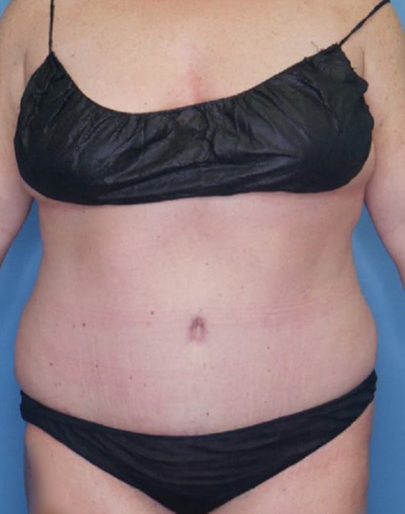 Tummy Tuck (Abdominoplasty)  Before & After Gallery - Patient 83594421 - Image 2