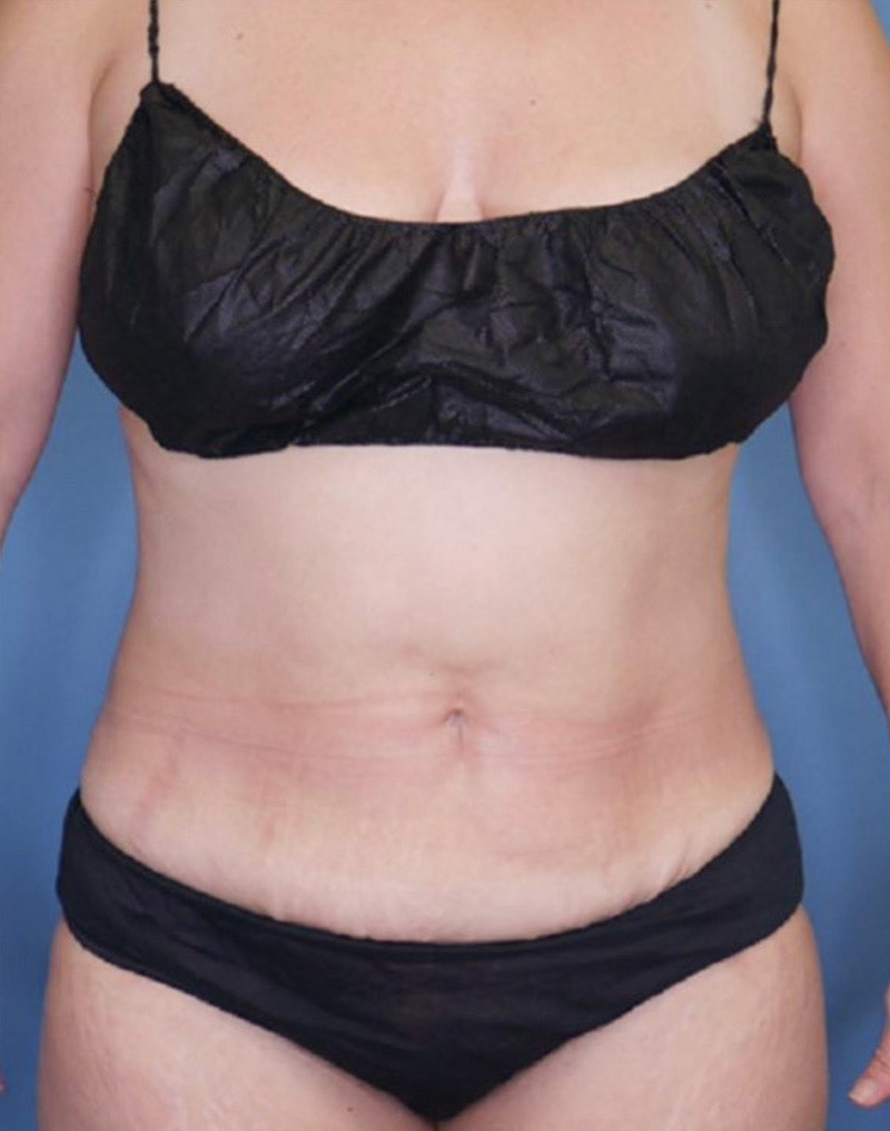Tummy Tuck (Abdominoplasty)  Before & After Gallery - Patient 83594418 - Image 2