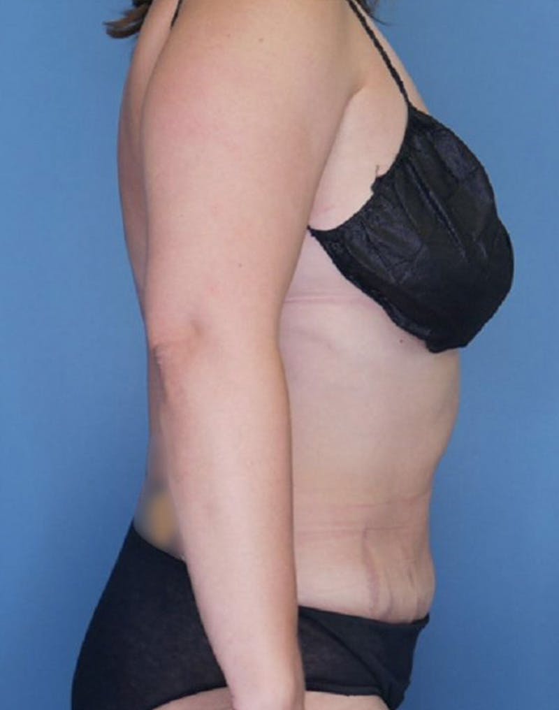 Tummy Tuck (Abdominoplasty)  Before & After Gallery - Patient 83594418 - Image 4