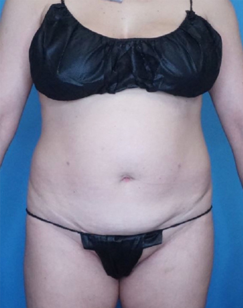 Tummy Tuck (Abdominoplasty)  Before & After Gallery - Patient 83369230 - Image 1