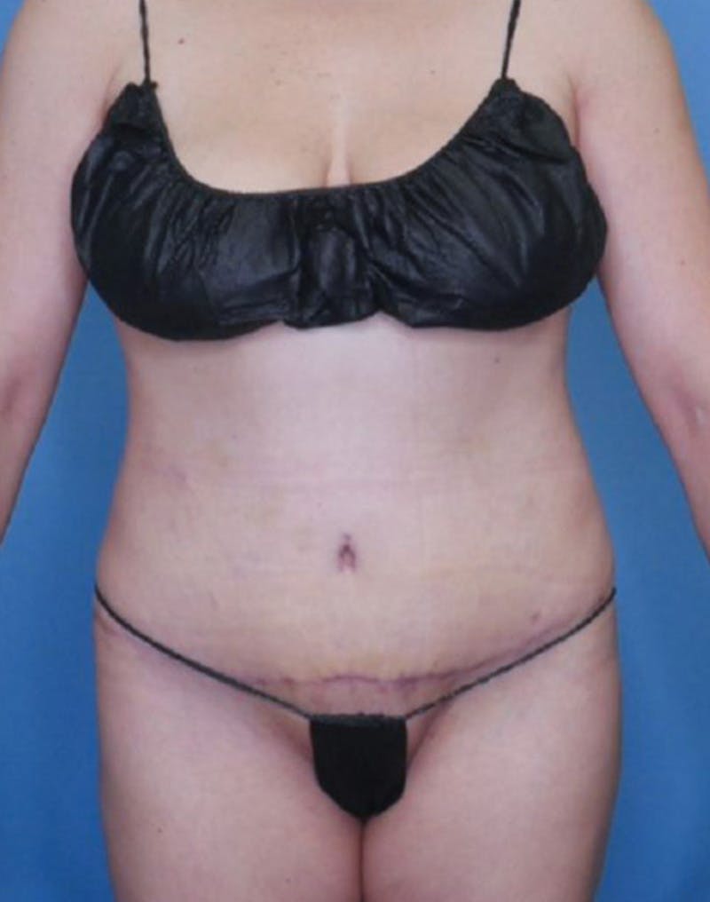 Tummy Tuck (Abdominoplasty)  Before & After Gallery - Patient 83369230 - Image 2