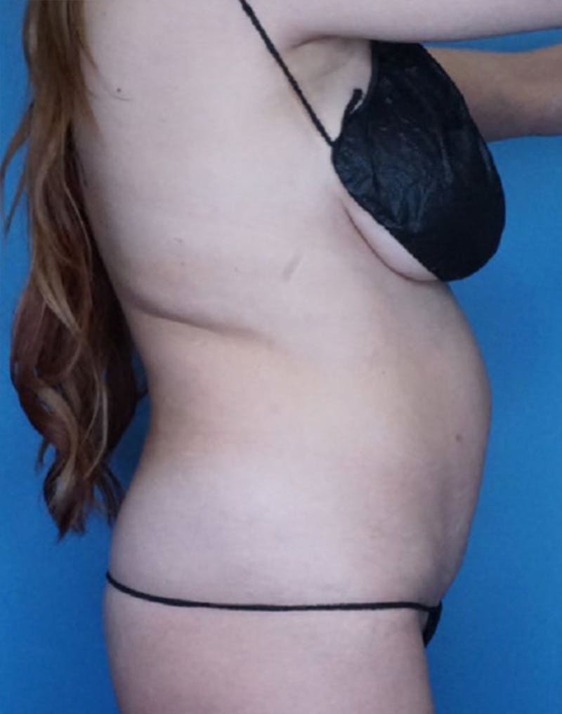 Tummy Tuck (Abdominoplasty)  Before & After Gallery - Patient 83369230 - Image 3