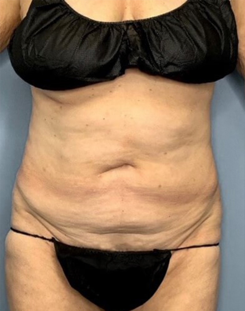 Tummy Tuck (Abdominoplasty)  Before & After Gallery - Patient 55612922 - Image 1