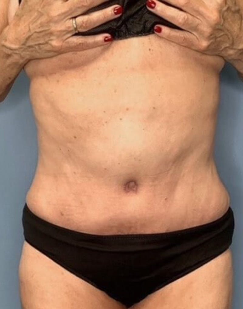 Tummy Tuck (Abdominoplasty)  Before & After Gallery - Patient 55612922 - Image 2